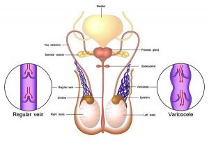 Bệnh giãn tĩnh mạch thừng tinh là gì